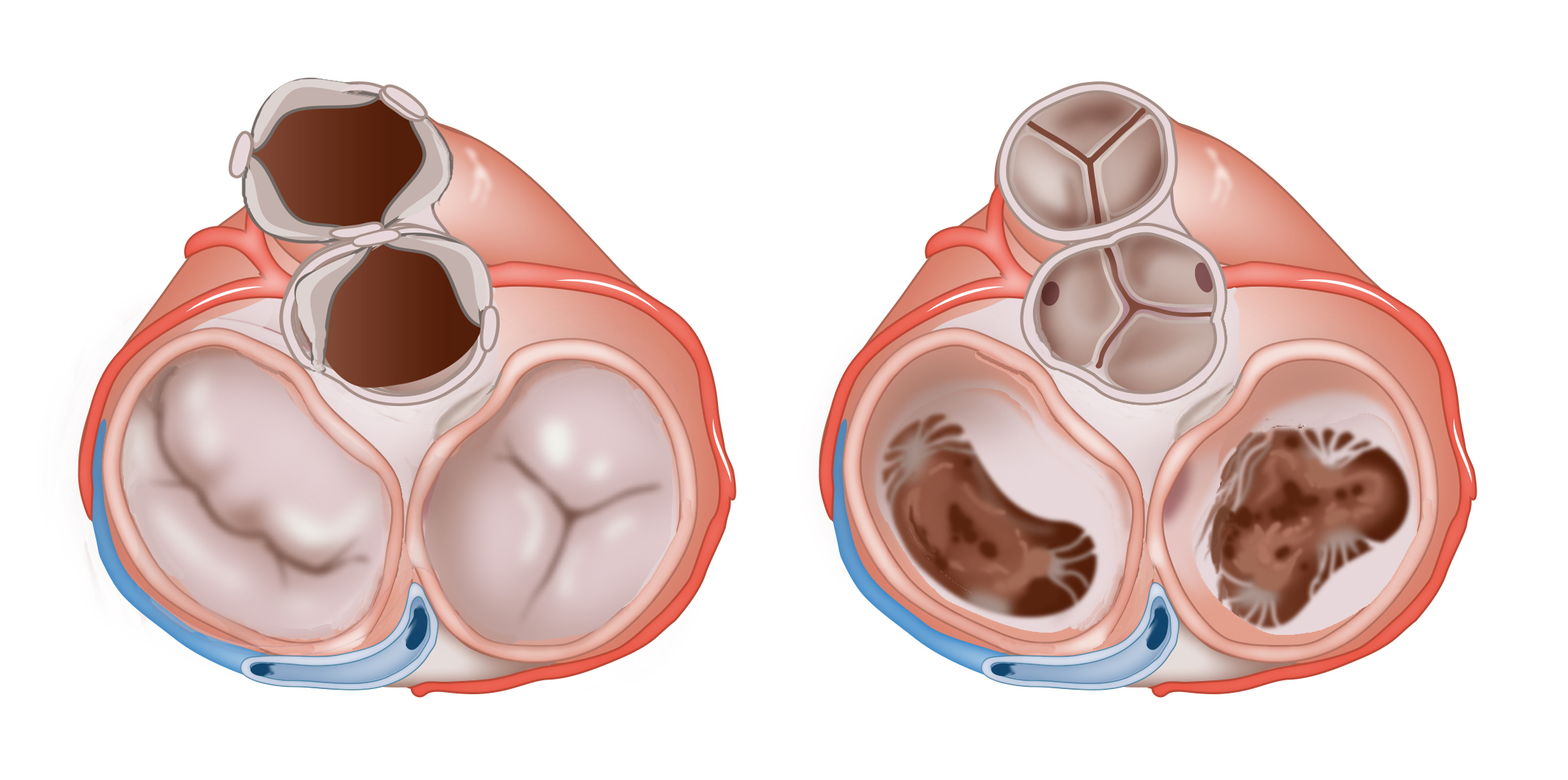 pin-on-heart-valve-disease